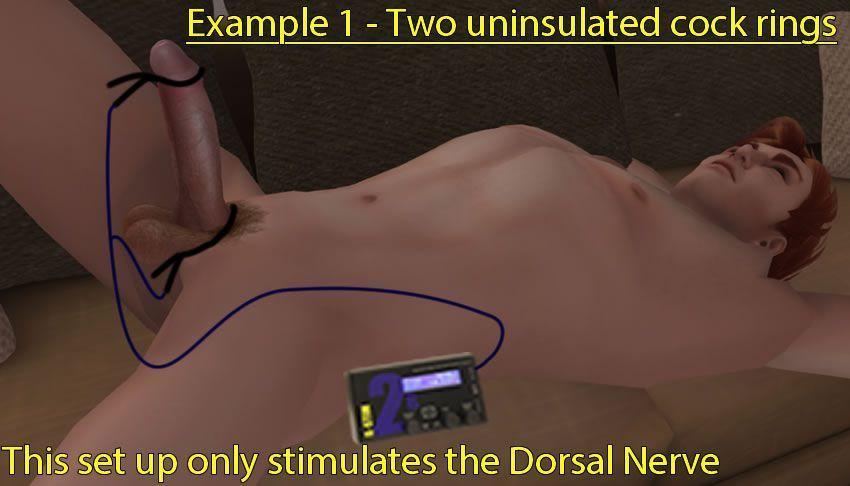 Bild som visar två kukringar som stimulerar Dorsal nerv