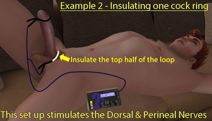 Bild som visar två kukringar som stimulerar både Dorsal & Perineal Nerver