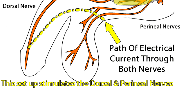 Bild, das den aktuellen Pfad zeigt, wenn eine modifizierte Schleife an der Basis des Penis hinter den Hoden verwendet wird