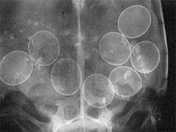 Image showing x-ray picture of implanted eggs