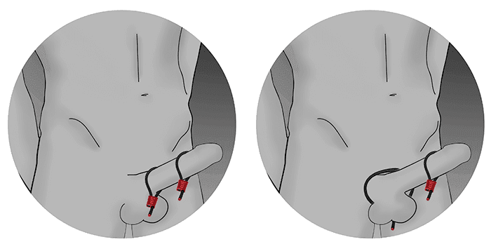 Two options showing how to wear them (c) Electrastim.co.uk